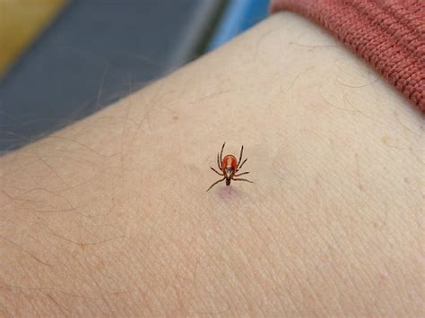 Tick Removal From Humans