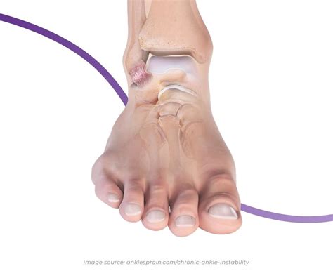 Chronic Ankle Instability: Causes, Symptoms & Treatment