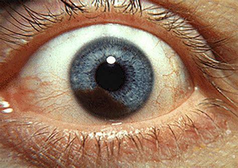 Eye melanoma: Symptoms, causes, and risk factors