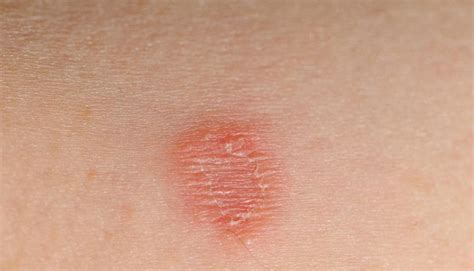 Fungal Rash On Skin