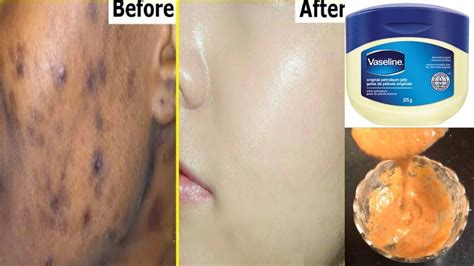 Remove Dark Spots In Just 3 Days With Vaseline | Get Rid Of Uneven Skin ...