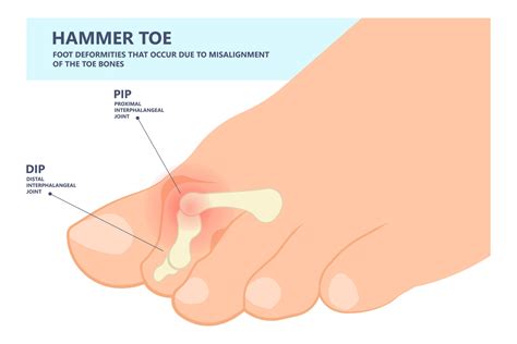 Hammertoe Symptoms, Causes & Treatments | Advanced Surgery Center