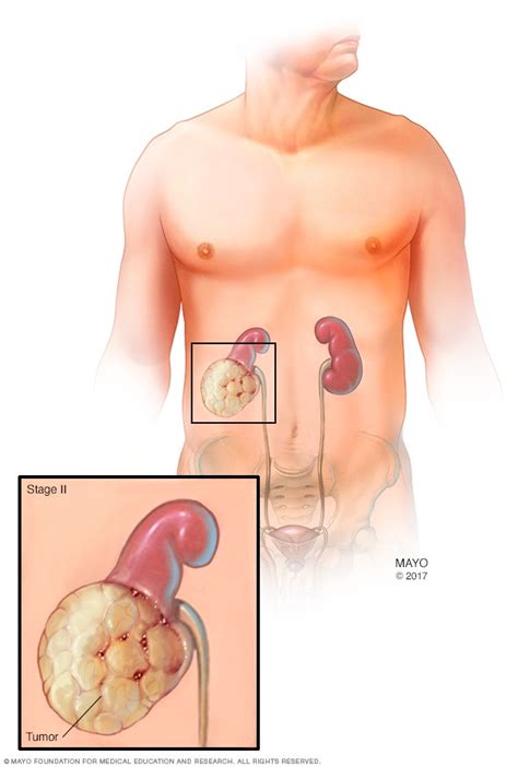 Kidney cancer - Diagnosis and treatment (2022)