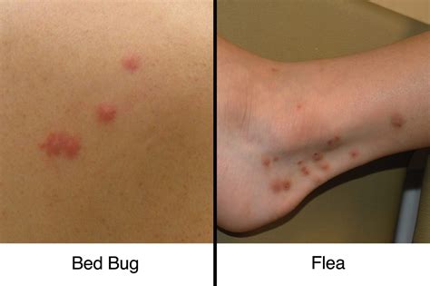 Do Bed Bug Bites Look Like Flea Bites - Pest Phobia