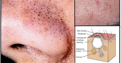 Acne : Causes, Pictures, Symptoms And Treatment