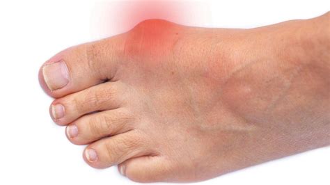 How To Treat A Bunion On Your Foot Outlet | emergencydentistry.com