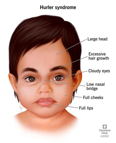 Mucopolysaccharidosis - CatPedia