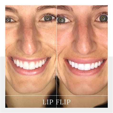 We’ve been getting a lot of inquiries about Botox lip flips lately 🧐 ...