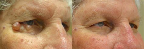 Eyelid Growth Removal Archives - In Focus Ophthalmic Plastic Surgery