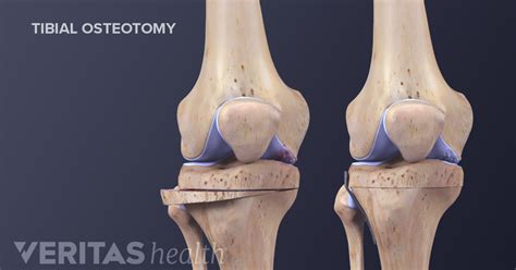 Knee Osteotomy Recovery