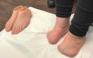 Your foot after amputation | Consulting Footpain