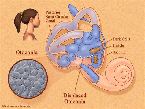 Benign Paroxysmal Positional Vertigo (BPPV) - marcaurel