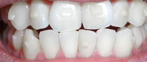 Invisalign Attachments - Comfortho, Smile Into Your Future ;)