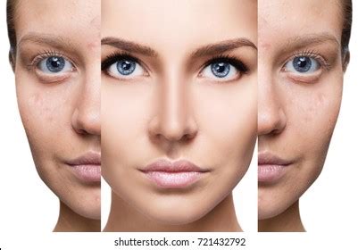 Woman Acne Before After Treatment Stock Photo 721432792 | Shutterstock