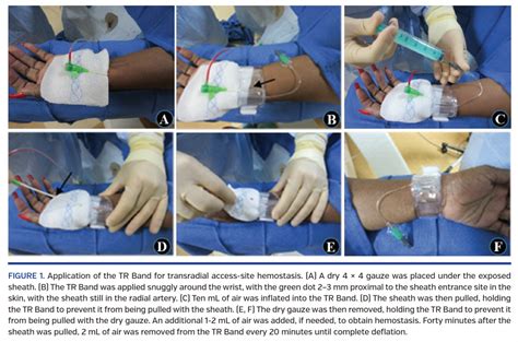 Comparison of Hemostasis Times With a Kaolin-Based Hemostatic Pad ...