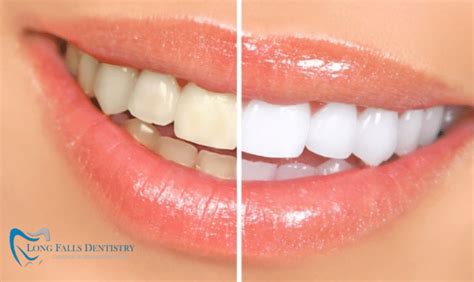 5 Tips to Prevent Yellow Teeth to Brighten Up Your Smile