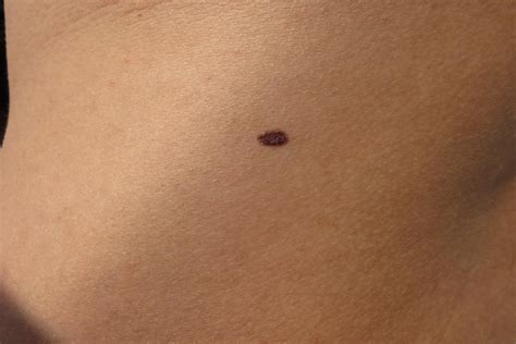 New moles and what to look out for - Medical News Corner