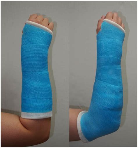 Distal Radius Fracture Splint UK Pre | ids-deutschland.de