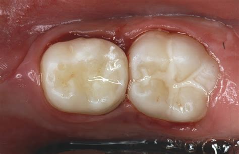 Glass Ionomer Cements for Primary Teeth - Pediatric Dentistry