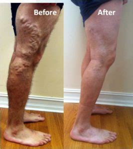 Does Medicaid Cover Varicose Vein Treatment?