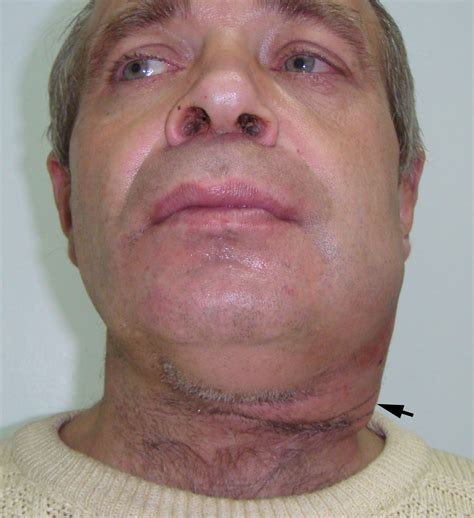 Obstructive Submandibular Sialadenitis Complicated with Severe Neck ...