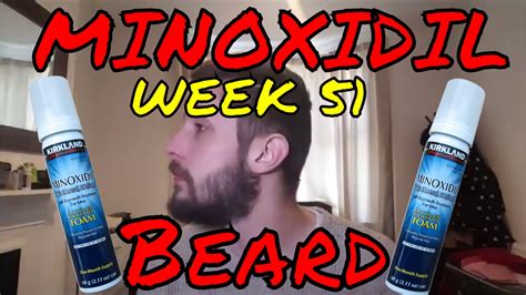 Minoxidil Beard Growth Results | Week 51 | Minoxidil 5% for Beard ...