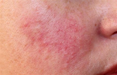 Recent Advances in Understanding and Managing Rosacea - Page 2 of 2 ...