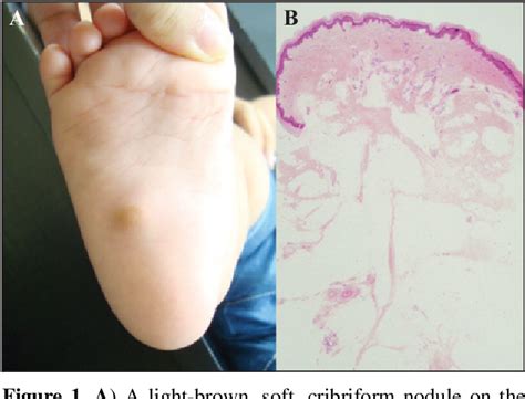 Figure 1 from Congenital nevus lipomatosus cutaneous superficialis of ...