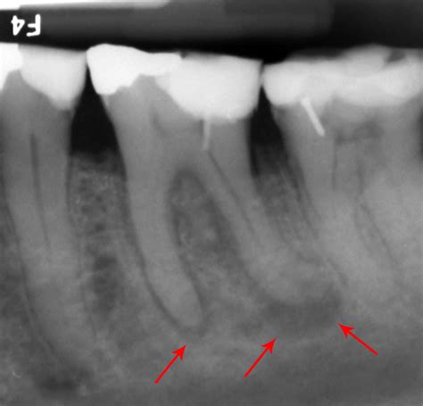 What Causes a Tooth to Abscess? - Dental Health Society