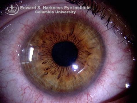 Corneal Neovascularization | Vagelos College of Physicians and Surgeons