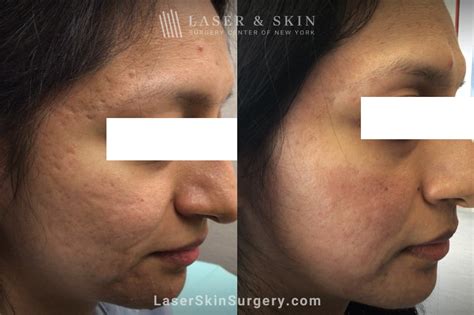 Acne Scars Treatment in New York - Laser NY