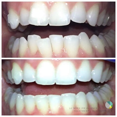 DM Clear Aligners