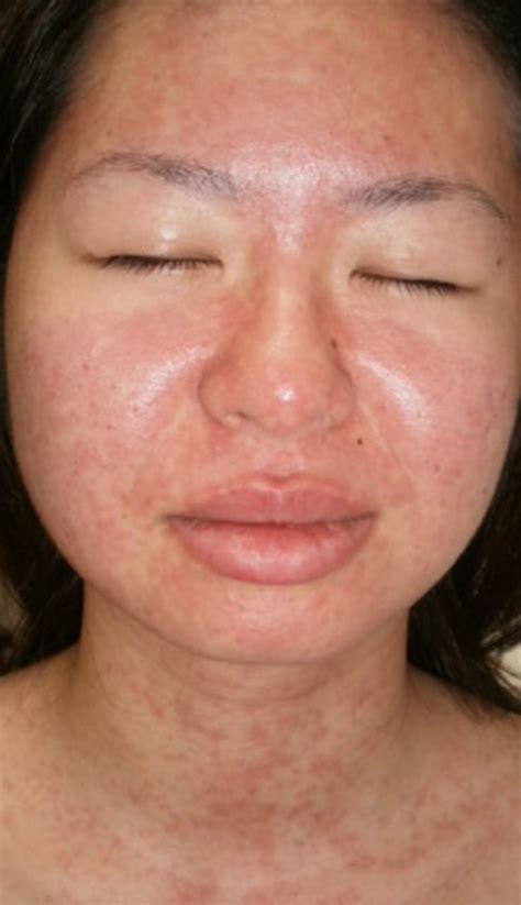 Skin rash in a patient with infectious mononucleosis | BMJ Case Reports