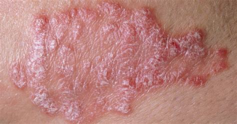 Ssurvivor: Discoid Malar Rash Sle