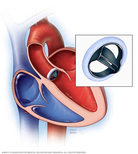 Aortic valve stenosis: Causes, Symptoms & Treatments | Global Treatment ...