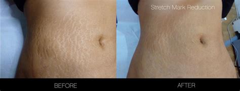 How To Get Rid Of Stretch Marks | Toronto | SpaMedica