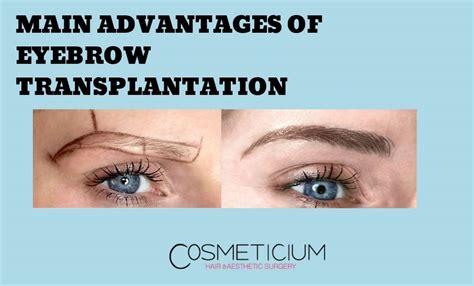 What are the Main Advantages of Eyebrow Transplantation? - Cosmeticium