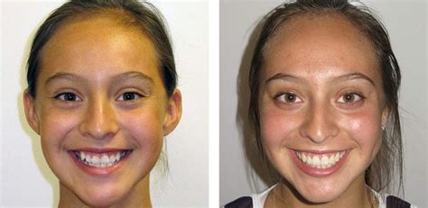 Clear Bracket Braces Before And After