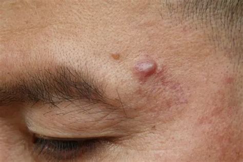 Cyst Removal | causes, diagnosis, treatment options, pictures