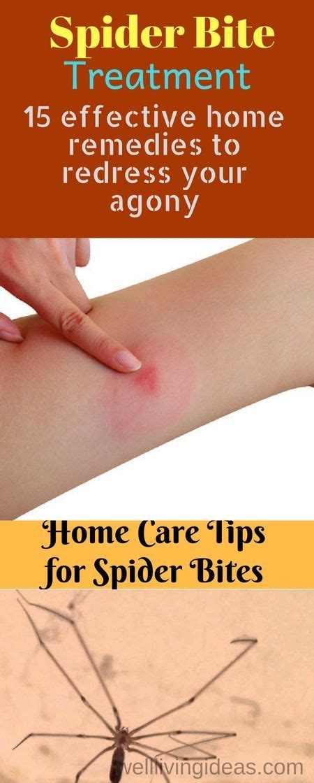 15 Home Remedies to Treat a Spider Bite Quickly at Home | Spider bites ...