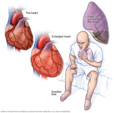 Heart failure - Symptoms and causes - Mayo Clinic