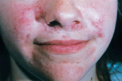 Perioral Dermatitis: Here's How to Treat It | The Healthy