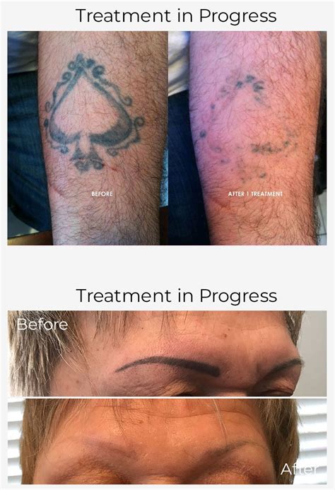 Why Tattoo Removal? - TattooRemovers.ink