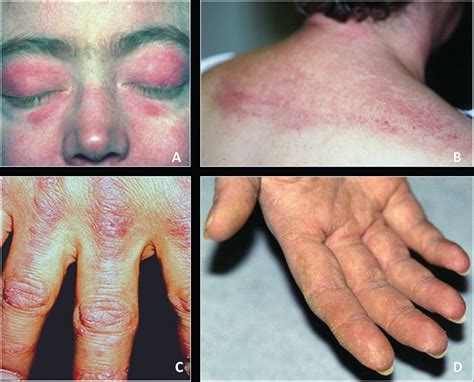 Periorbital Edema Dermatomyositis