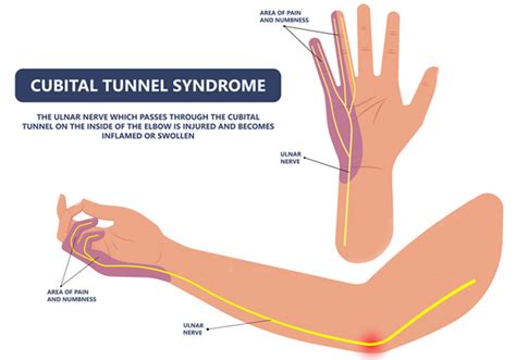 Cubital Tunnel Syndrome – Shoulder Elbow