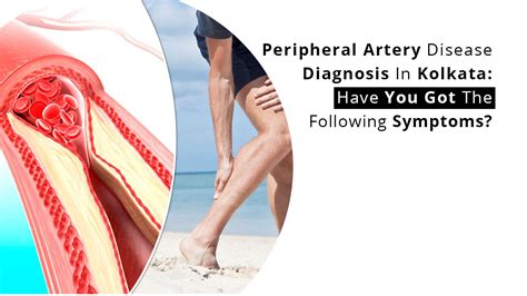 Peripheral Artery Disease Diagnosis In Kolkata: Have You Got The ...