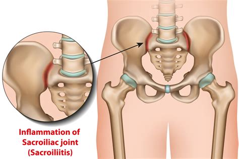 Sacroiliac Joint Dysfunction Causes, Symptoms & Treatment | Advanced ...