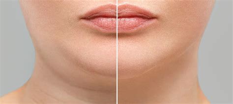 Botox for Sagging Jowls Before and After - SA