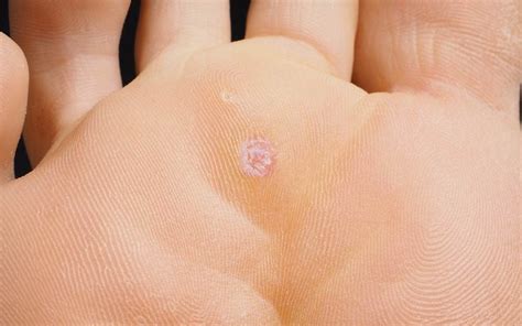 Plantar Wart Removal: How to Remove Warts with Duct Tape | Reader's Digest