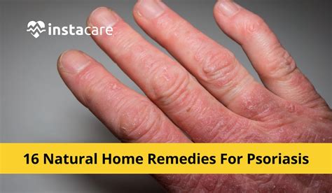 16 Natural Home Remedies For Psoriasis